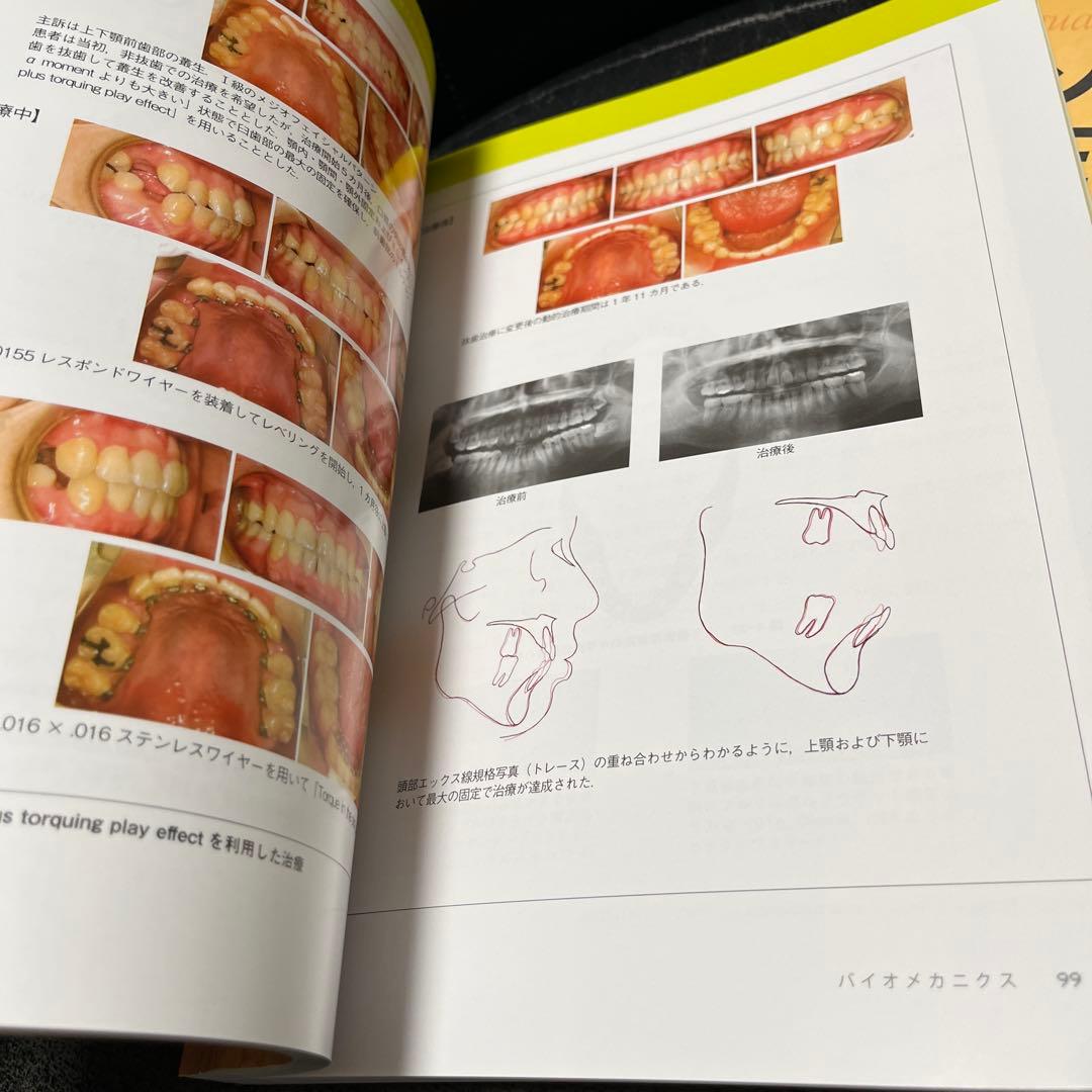 リンガルブラケット矯正法