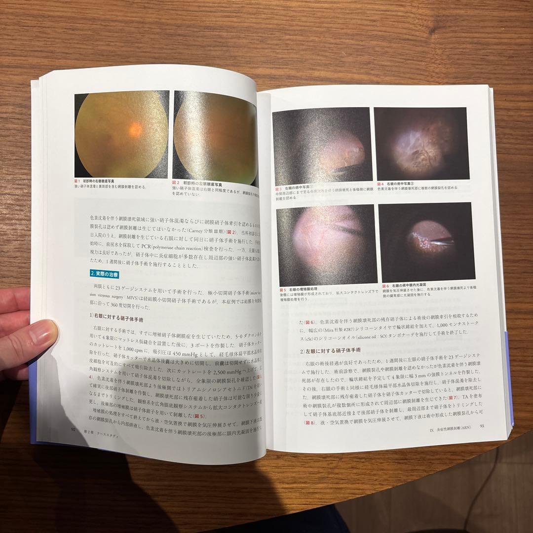 眼科　網膜剥離と極小切開硝子体手術（眼科臨床エキスパート）