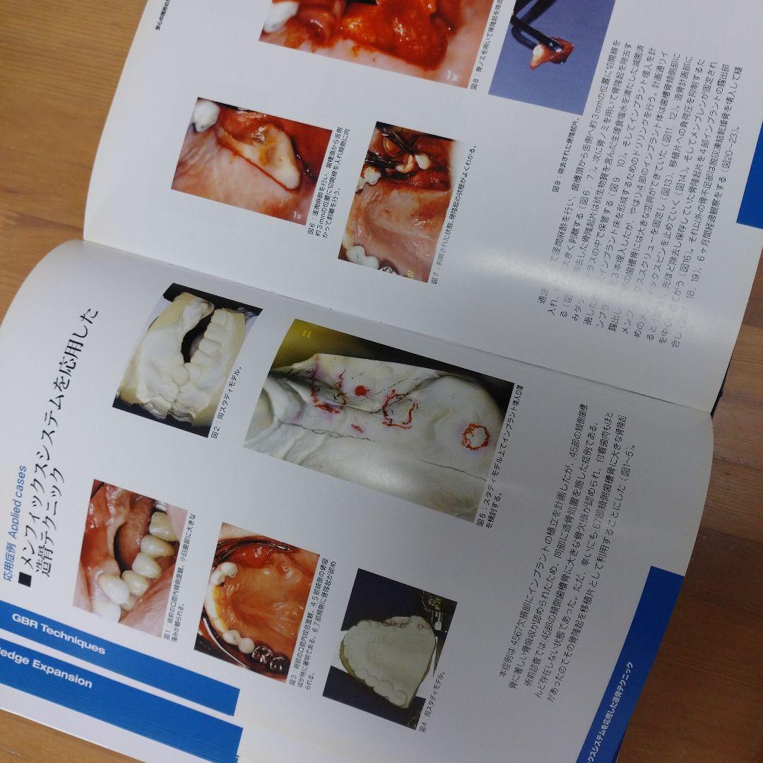 成功のインプラント学