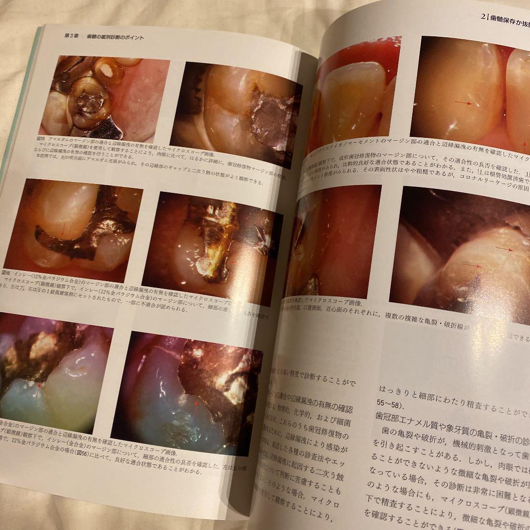 失敗しない歯髄保存療法 : 抜髄する前にもう一度歯髄診断をしよう