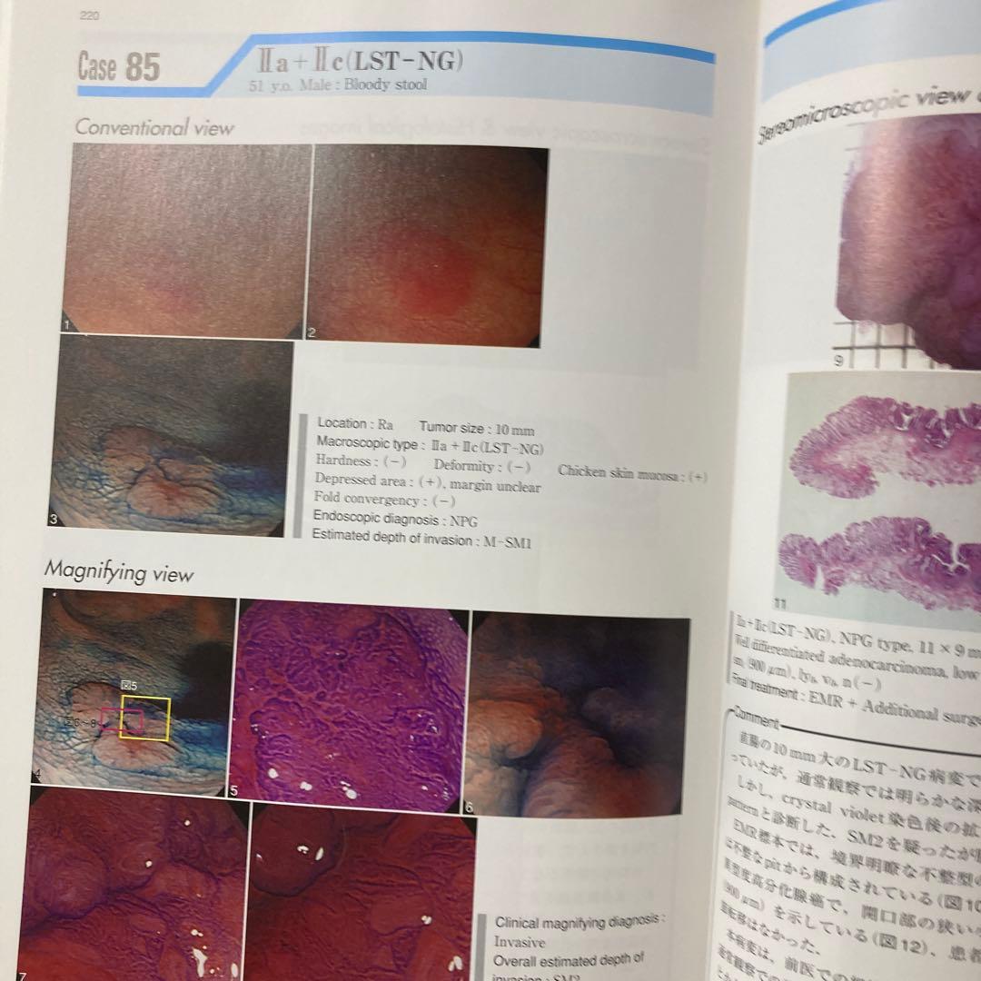 国立がんセンター大腸内視鏡診断アトラス