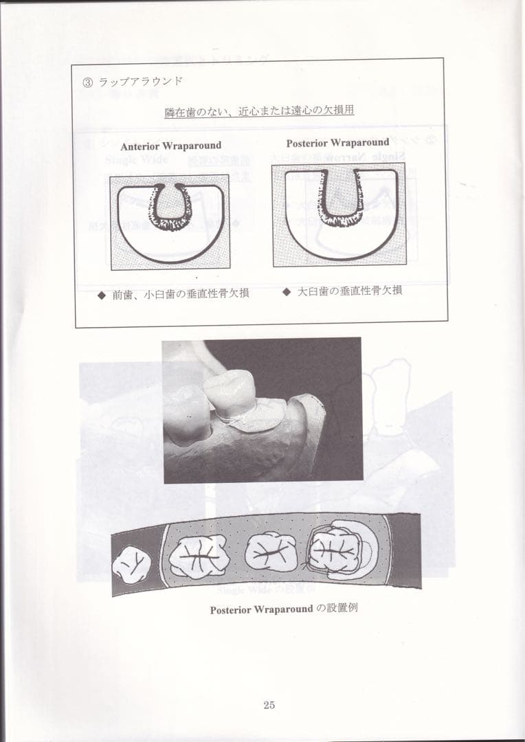 ゴアテックス　メンブレン　レジメ #歯科　　#インプラント　#GBR