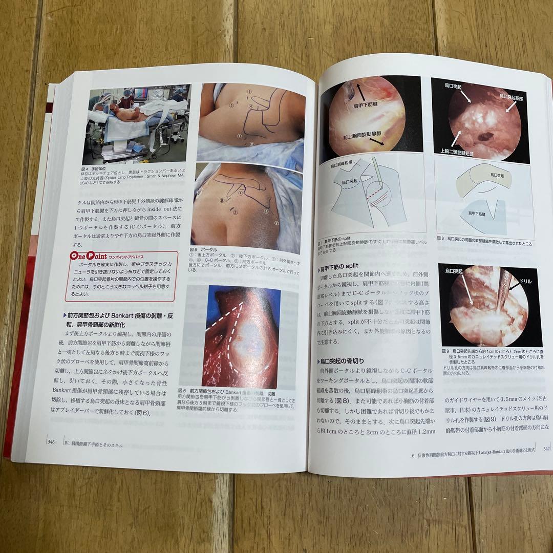 肩関節鏡下手術
