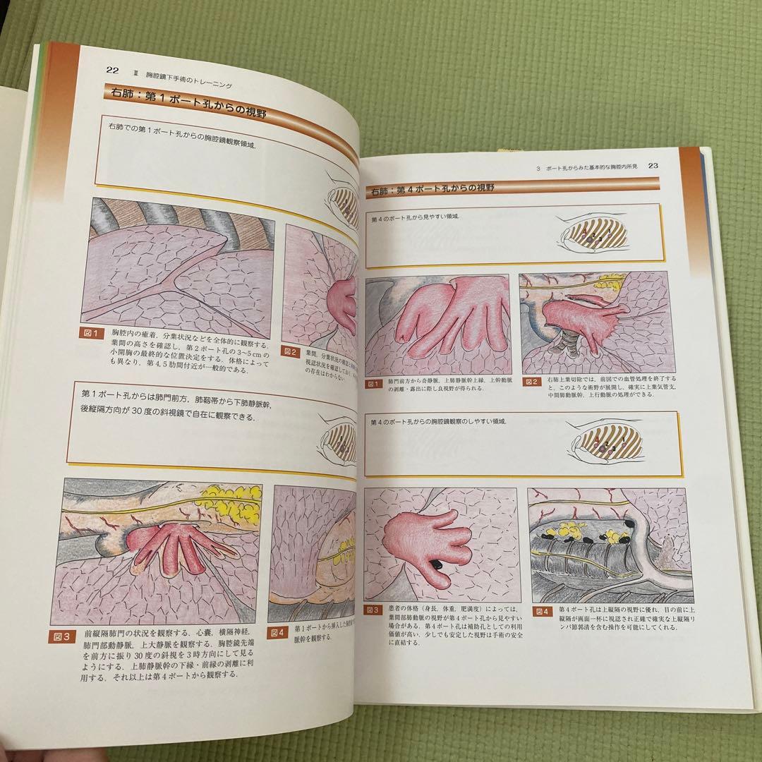 カラーアトラス胸腔鏡下肺癌手術 イラストとDVDで学ぶ術式のポイント