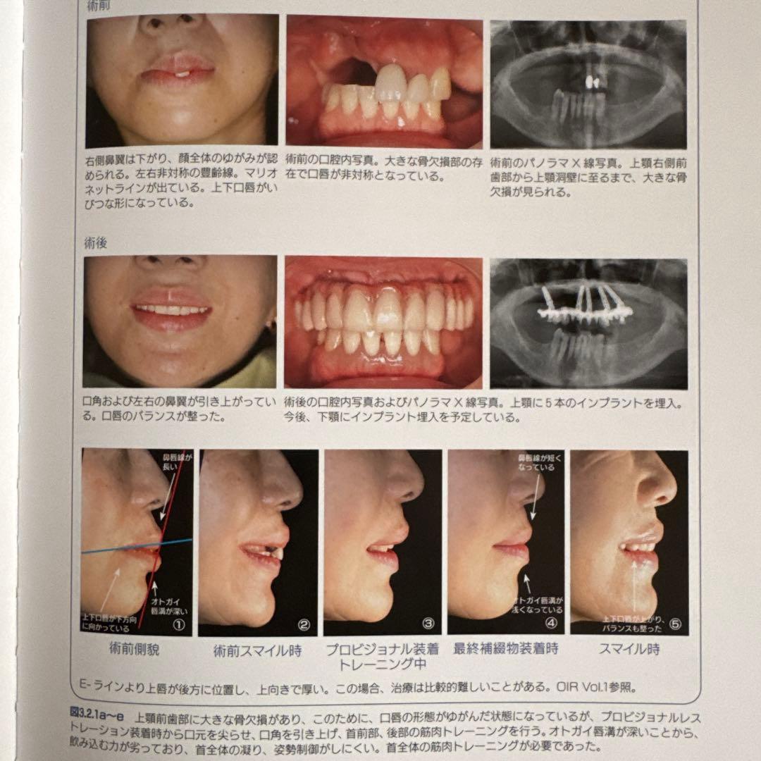 オーラルインプラント